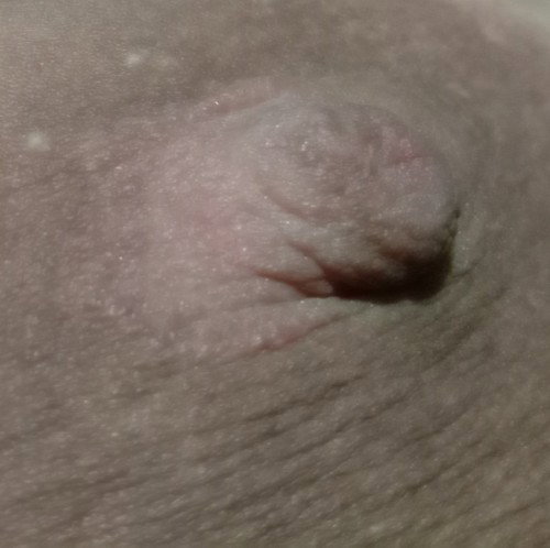 หัวนมเป็นแผล