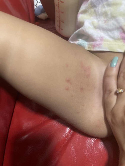 2 year old having red bumps on private area