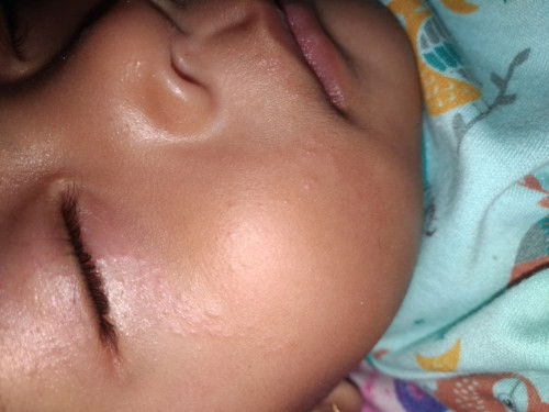 Bintik seperti biang keringat tapi bentuknya....