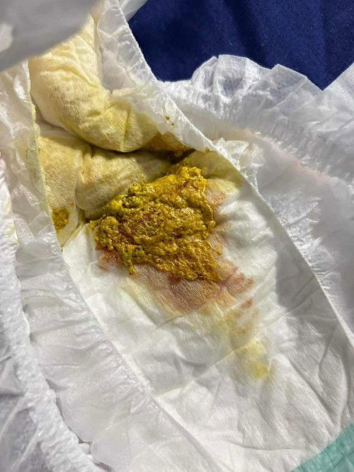 ถ่ายแล้วเป็นแบบนี้เกิดจากอะไร ?