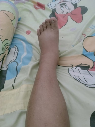 มีแม่บ้านไหนบวมแบบนี้มั้ยคะ