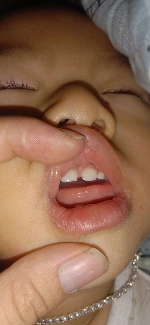 Dính thắng lưỡi