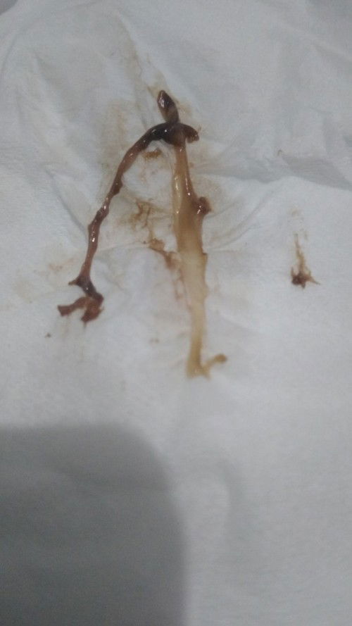 8w2d flek kecoklatan tanpa nyeri perut, mirip keputihan