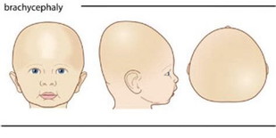 KEPALA BAYI TIDAK BULAT