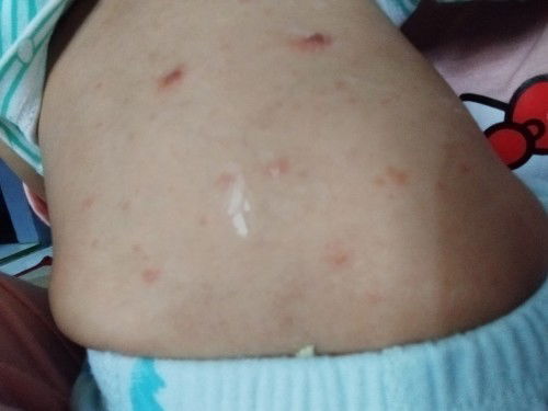 Merah merah di badan