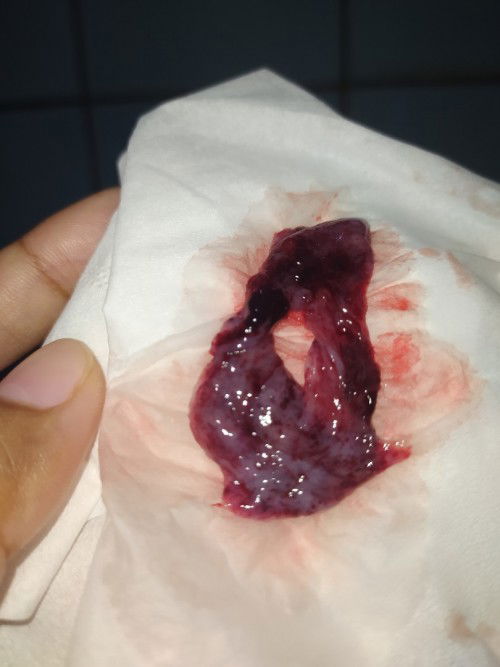 Apakah kantung janin?