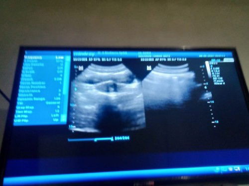 Hamil 10 Minggu belum kelihatan