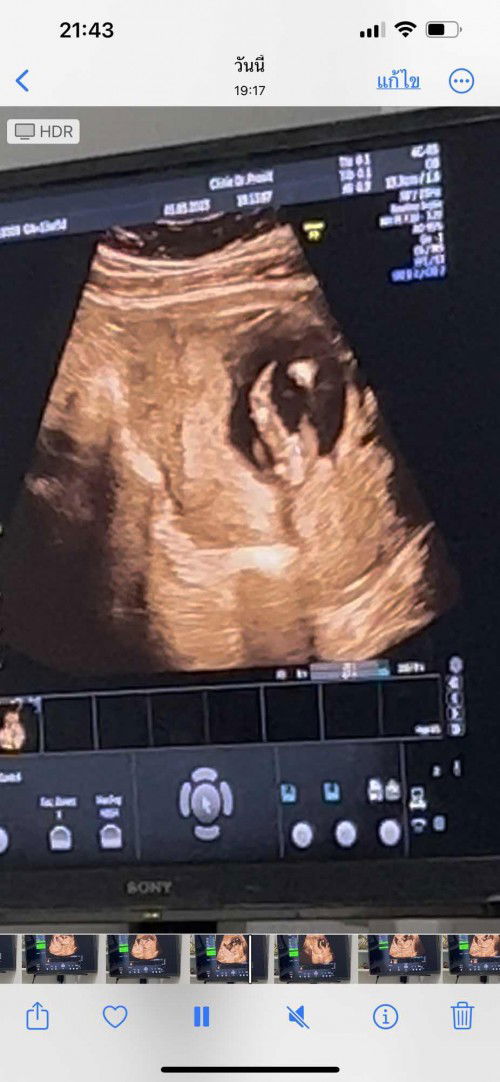 อัลตร้าซาวด์เพศลูก
