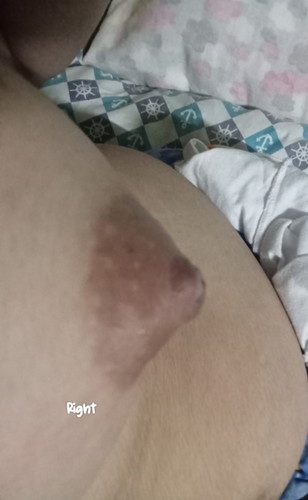 swollen areola