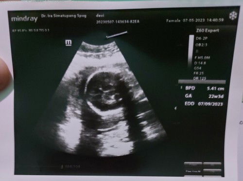 Hpl selalu mundur saat usg