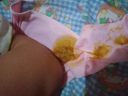 Bayi 3bulan sering bab