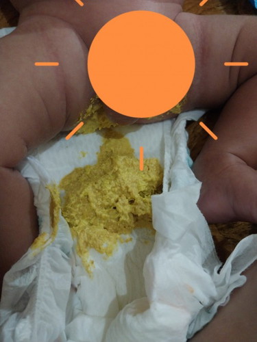 stelah ganti susu sgm bayi sy lebh sering pup kadang² stlah minum susu lngsung pup normal ap g y bun