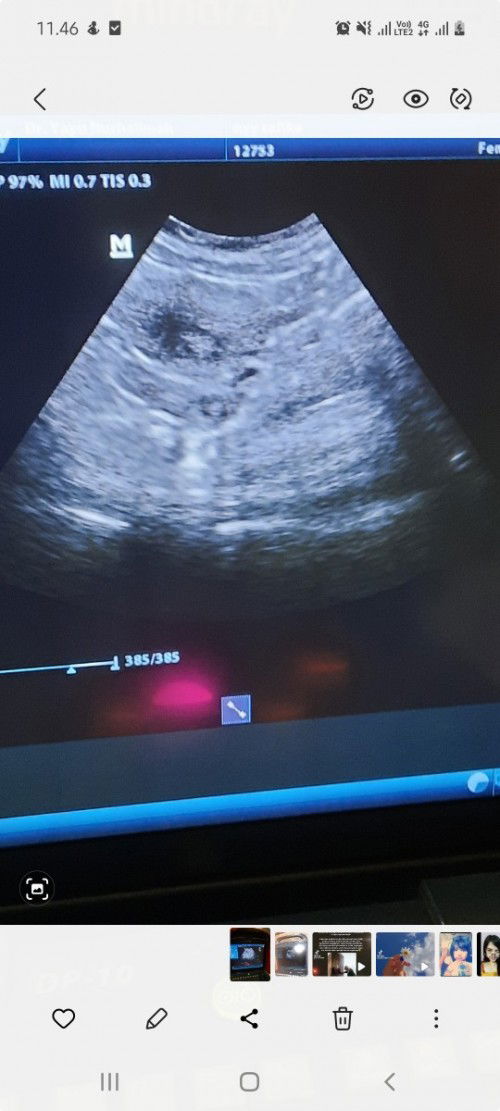 6week di usg blm ada kantung