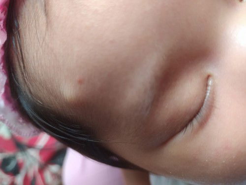 Benjolan pada kening anak