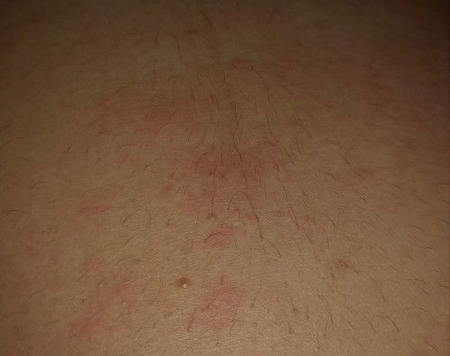 Gatal dan ruam pada perut