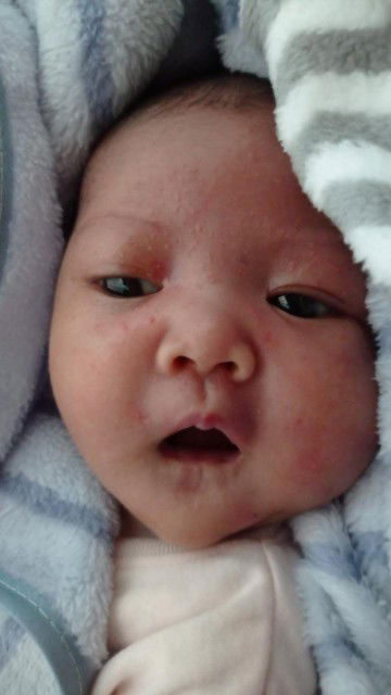 Bintik merah pada bayi