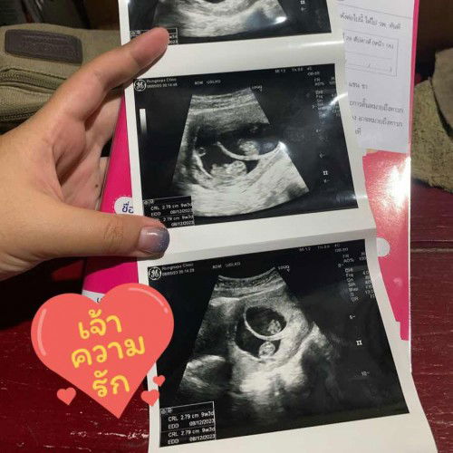 วิธีดูแลท้องแฝด