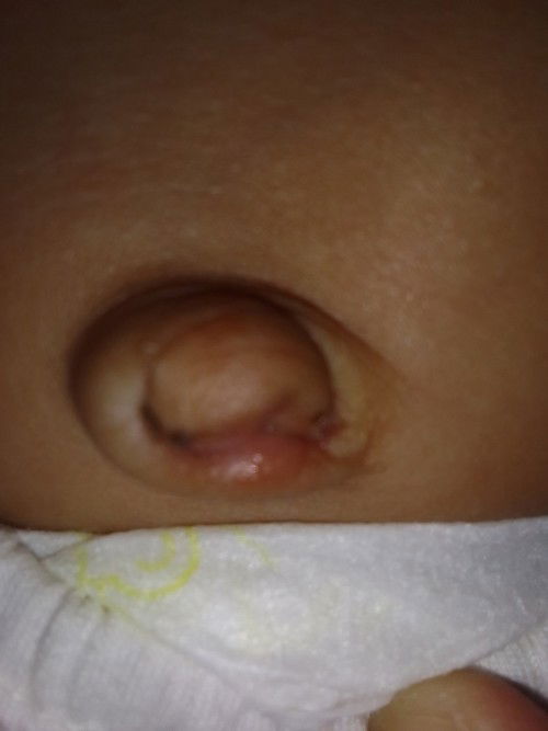 Pusod ni baby bat ganito