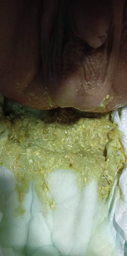 DIAPER POOP