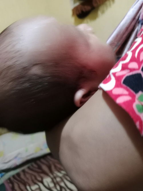Bun mau tanya dikepala bayi kaya ada yg pitak gitu, kenapa ya? Ada yg tau gak? Usia 3bln.