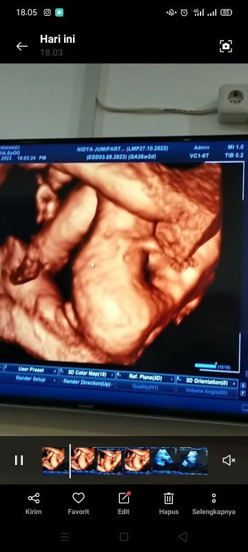 Hasil USG Jenis Kelamin