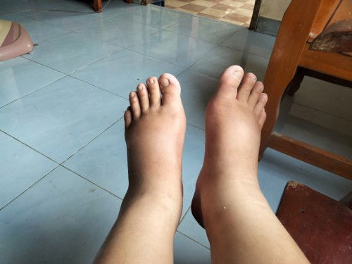 แม่ๆใครเท้าบวมเปล่งบ้างค่ะ33+5