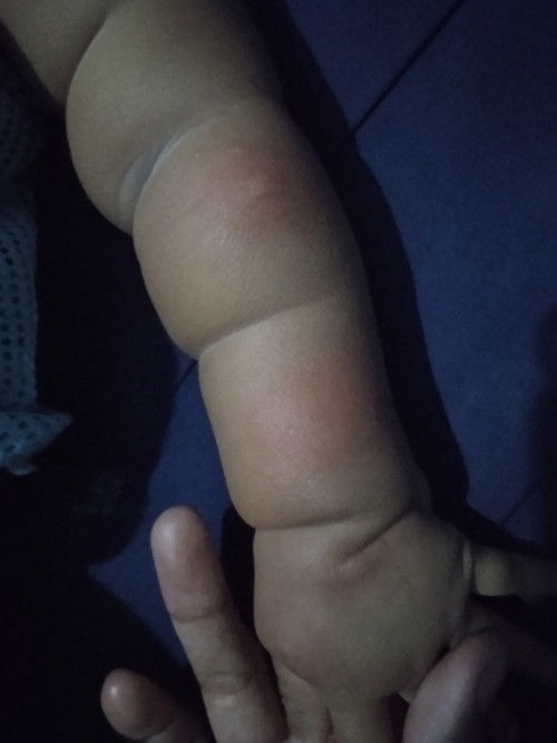 ตุมคัน ไข้เลือกออก มีเชื้อ