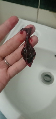 Miscarriage