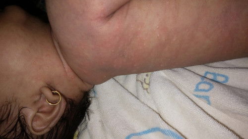 Bintik merah di badan bayi seperti gatal2