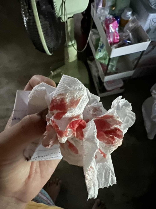 ตกเลือดหลังคลอด
