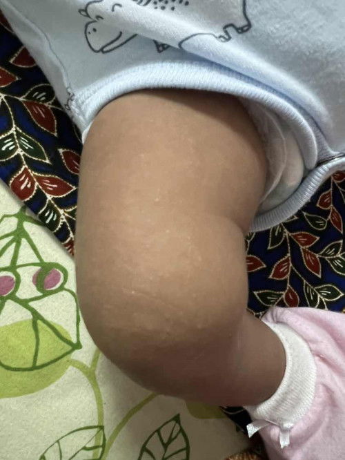 Bintik2 dibadan anak