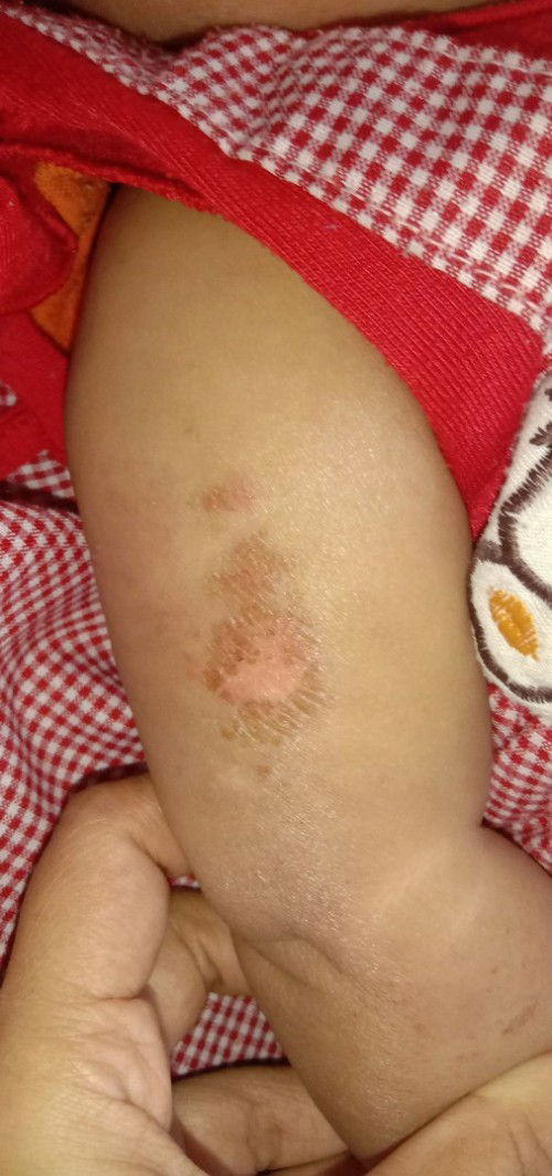 Bayi 4bulan Garuk2 Lengan Tangan, Kaki, dan Kepala sampai luka. Apakah Alergi??