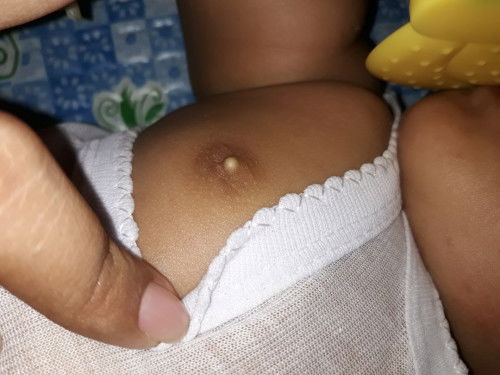 Bintik putih di payudara