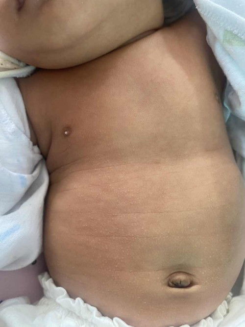 ปรึกษาแม่ๆเรื่องผดผื่นในเด็กค่ะ