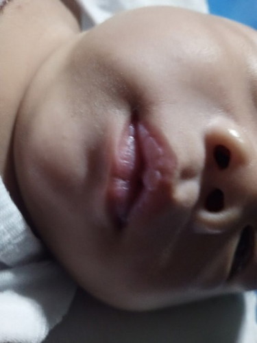 Normal ba Ang white lips Kay baby?