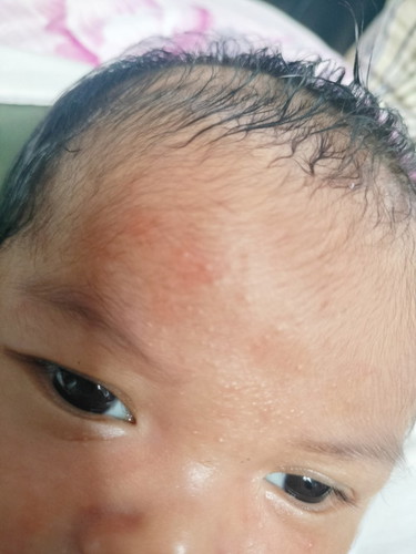 Face rash/acne?