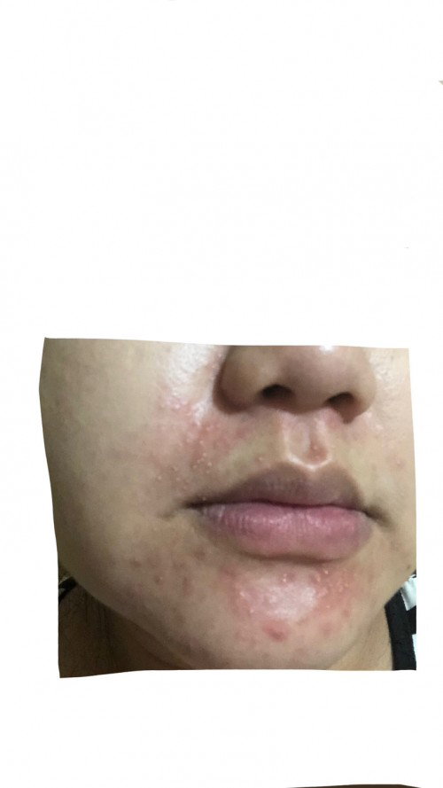 Rasher or pimple?
