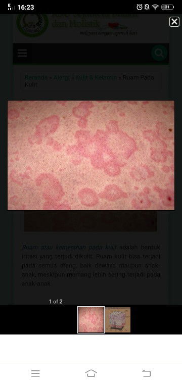 Hai bun ada yang tau gak aku lagi ngalamin ruam kaya gini kira2 kenapa ya rasanya gatal bangett