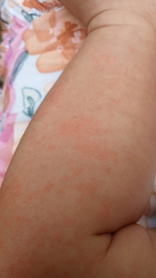 Biang keringat bukan ya mom?