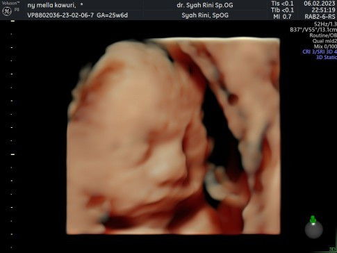 4D abal abal bikin trauma