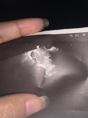 หลังจากมีเลือดออก