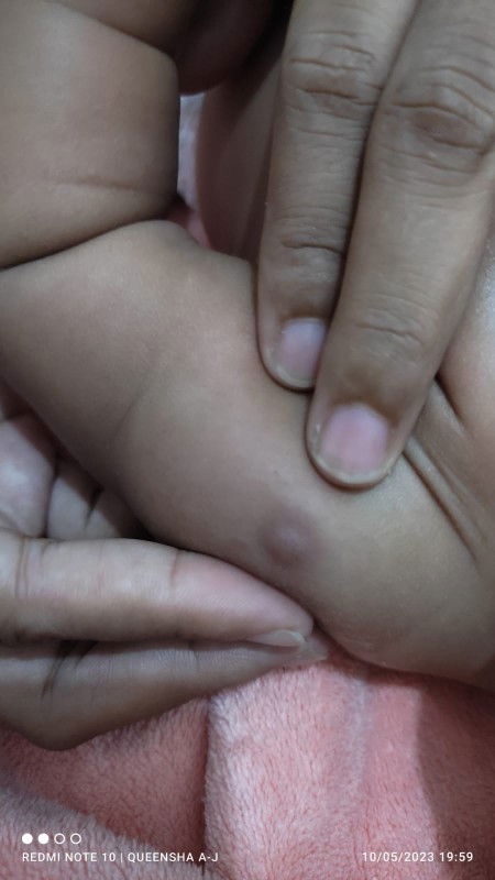 ijin bertanya Bun ini ada benjolan ke dalam warna ke unguan gitu.
Kira2 ini apa ya?