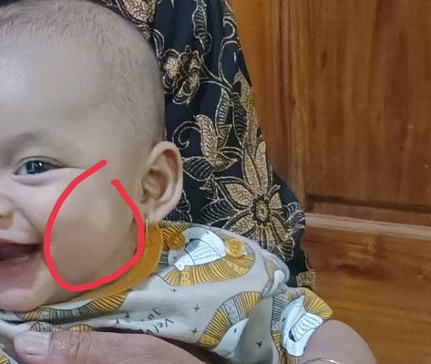 Bercak putih pada bayi