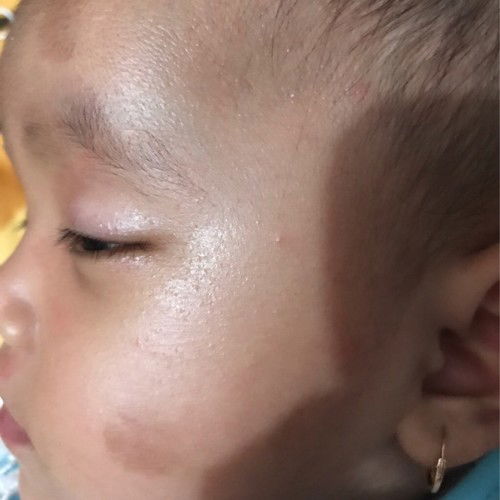 Bercak coklat pada Kulit bayi