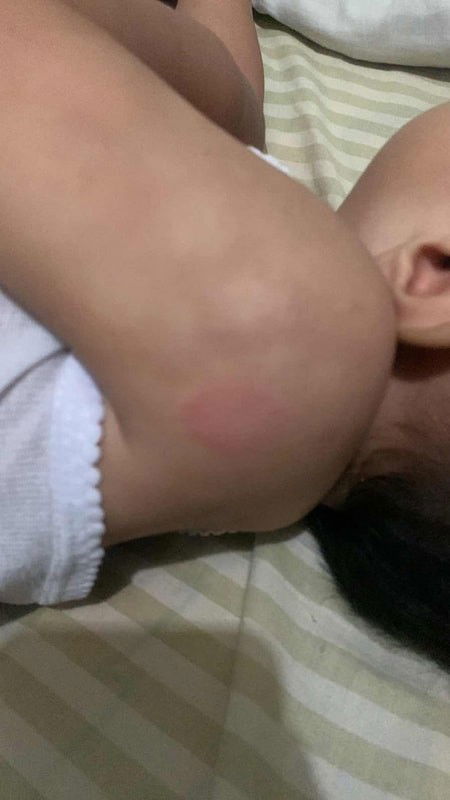 Bintik putih merah sperti panu