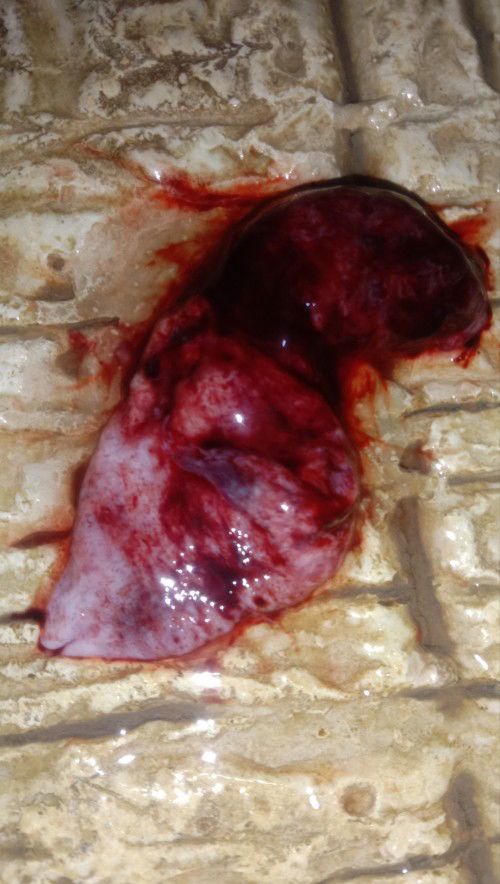 Diagnosa terancam aborsi/keguguran