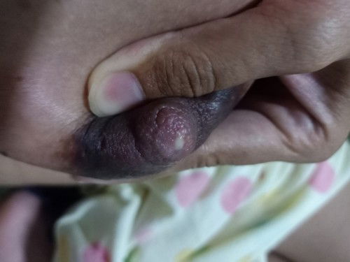 เต้านมอักเสบ