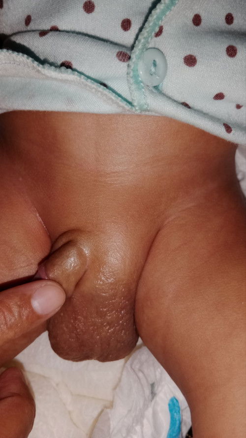 Benjolan di atas penis