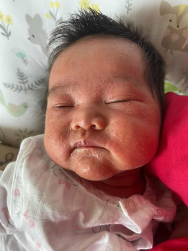 สะเก็ดเหลืองที่หน้าที่หัวเกิดจากอะไร ลูกเราเป็นผื่นตั้งแต่แรกเกิด ใครรู้วิธีแก้บ้าง