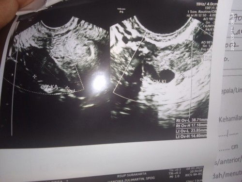 Hasil usg tranvaginal